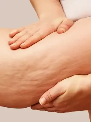 tratamento de lipedema em BH