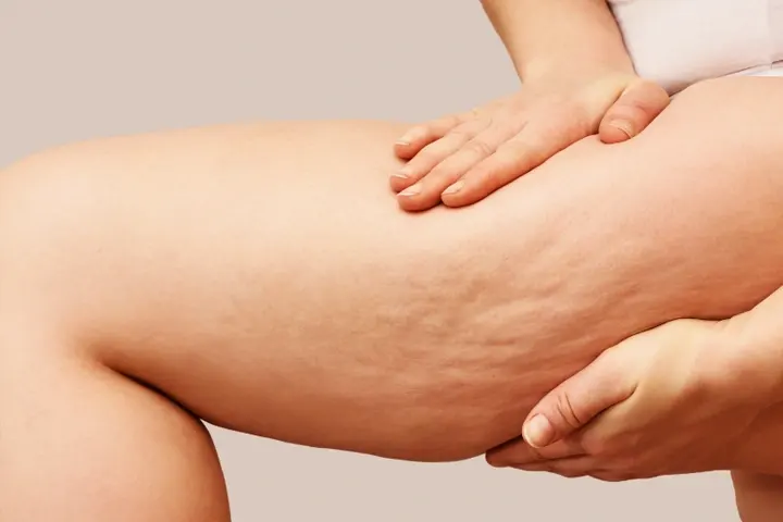 Tratamento para Lipedema em Belo Horizonte