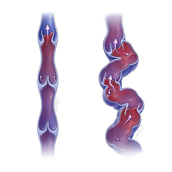 veias varicosas infográfico