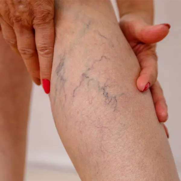 tratamento de varizes