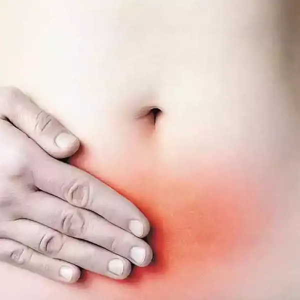 Varizes Pélvicas e Endometriose